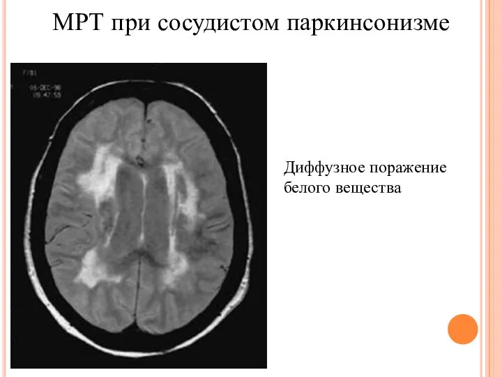 МРТ при сосудистом паркинсонизме Диффузное поражение белого вещества