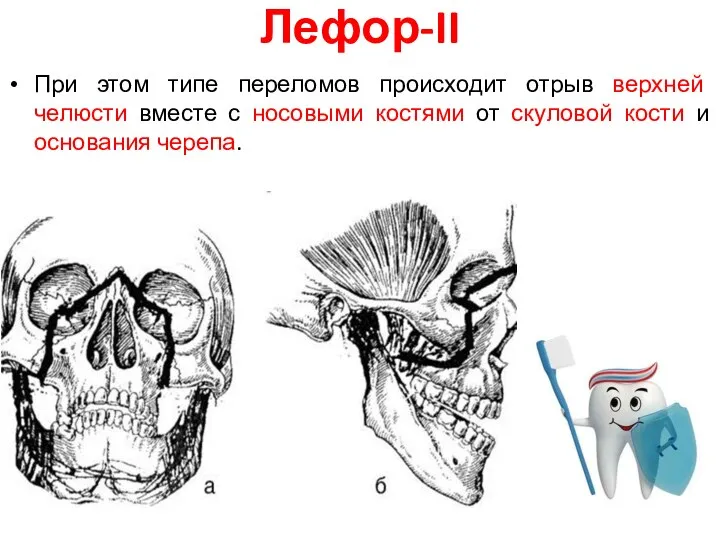 Лефор-II При этом типе переломов происходит отрыв верхней челюсти вместе с