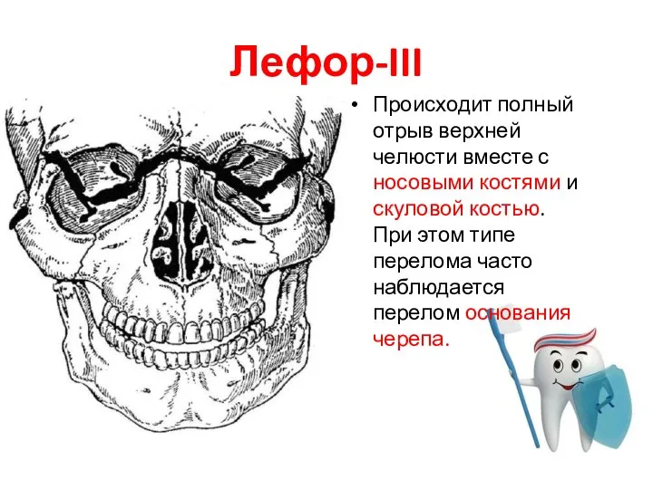 Лефор-III Происходит полный отрыв верхней челюсти вместе с носовыми костями и