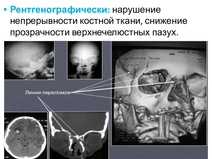 Рентгенографически: нарушение непрерывности костной ткани, снижение прозрачности верхнечелюстных пазух.