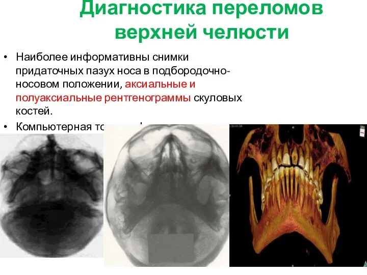 Диагностика переломов верхней челюсти Наиболее информативны снимки придаточных пазух носа в