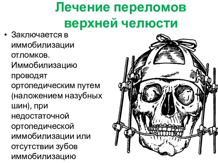 Лечение переломов верхней челюсти Заключается в иммобилизации отломков. Иммобилизацию проводят ортопедическим