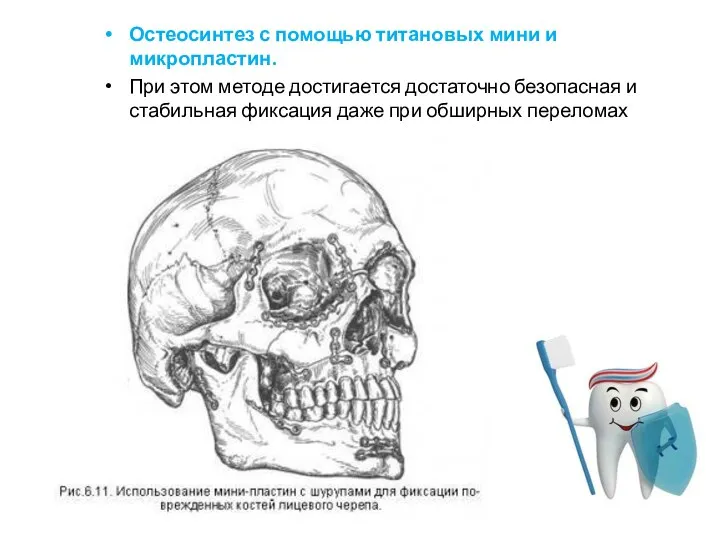 Остеосинтез с помощью титановых мини и микропластин. При этом методе достигается