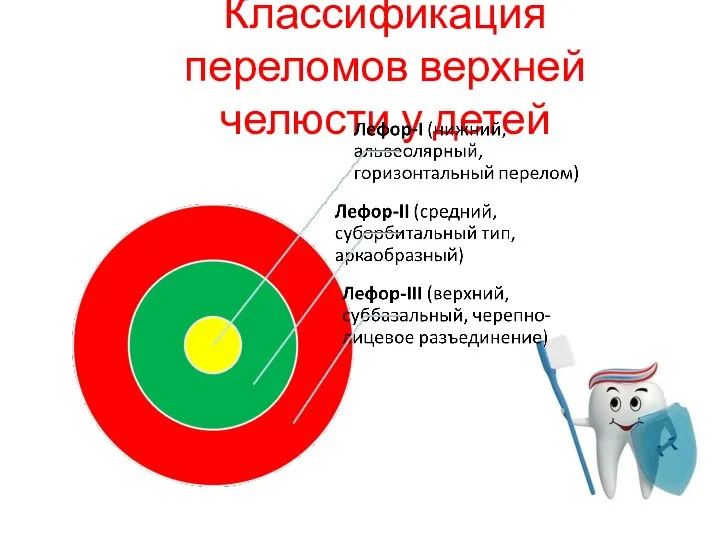 Классификация переломов верхней челюсти у детей