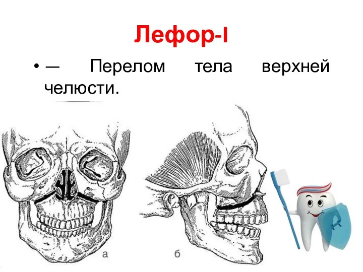 Лефор-I — Перелом тела верхней челюсти.