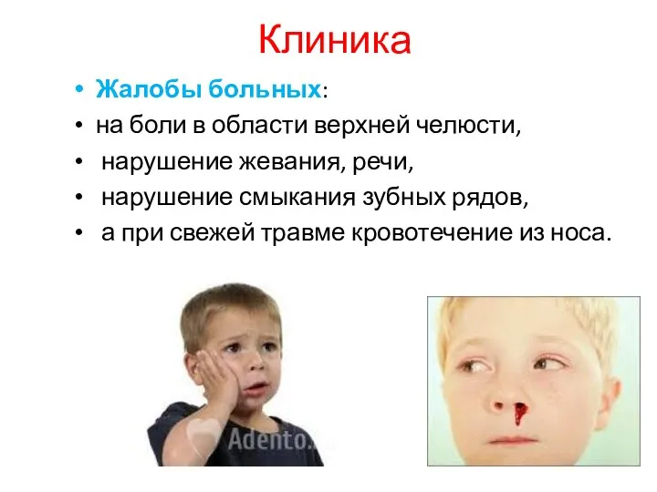 Клиника Жалобы больных: на боли в области верхней челюсти, нарушение жевания,