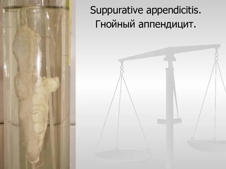 Suppurative appendicitis. Гнойный аппендицит.