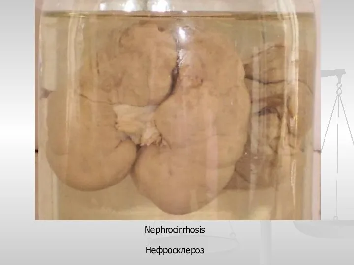 Nephrocirrhosis Нефросклероз