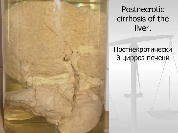 Postnecrotic cirrhosis of the liver. Постнекротический цирроз печени