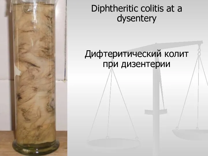 Diphtheritic colitis at a dysentery Дифтеритический колит при дизентерии