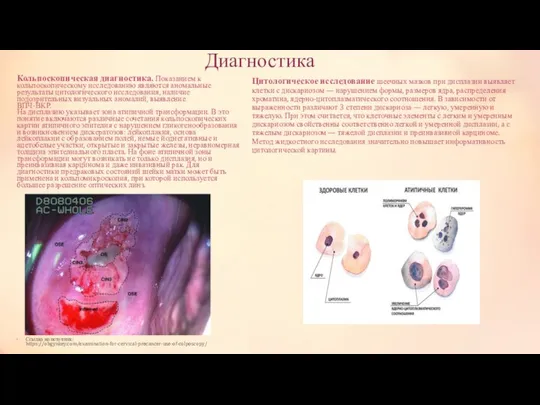 Диагностика Кольпоскопическая диагностика. Показанием к кольпоскопическому исследованию являются аномальные результаты цитологического