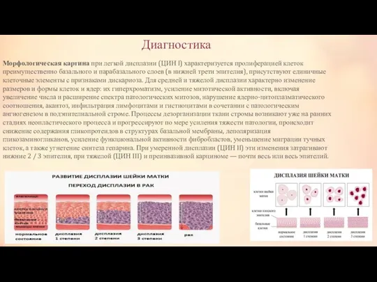 Диагностика Морфологическая картина при легкой дисплазии (ЦИН I) характеризуется пролиферацией клеток