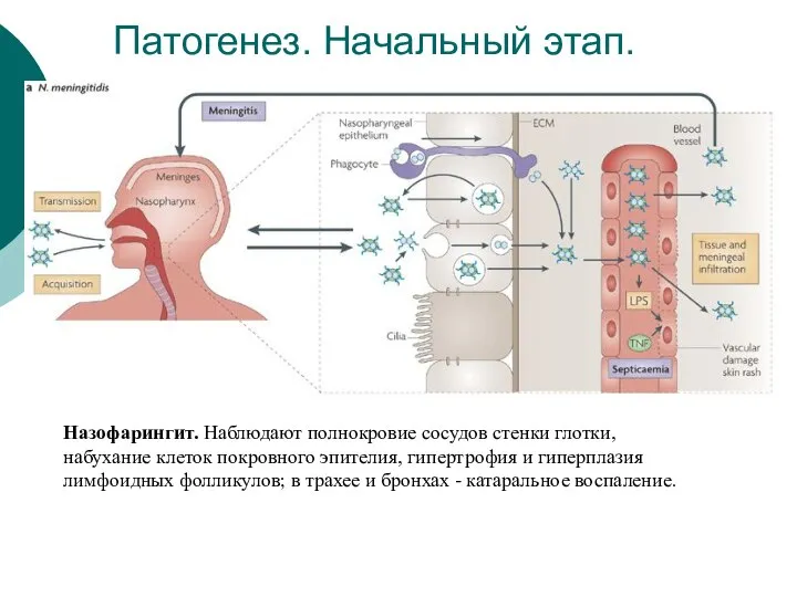 Патогенез. Начальный этап. Назофарингит. Наблюдают полнокровие сосудов стенки глотки, набухание клеток