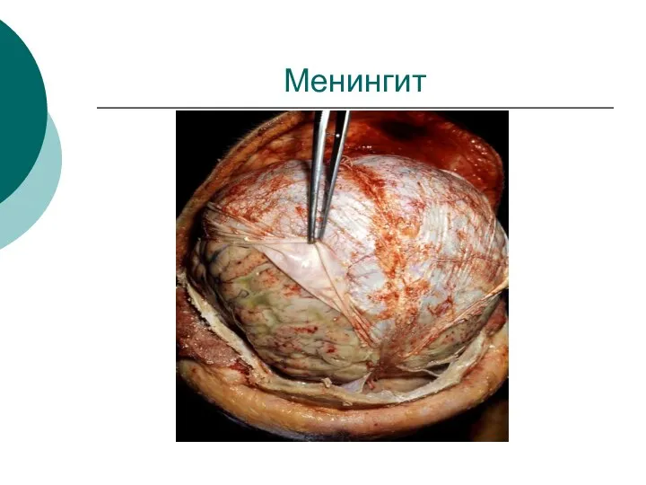 Менингит