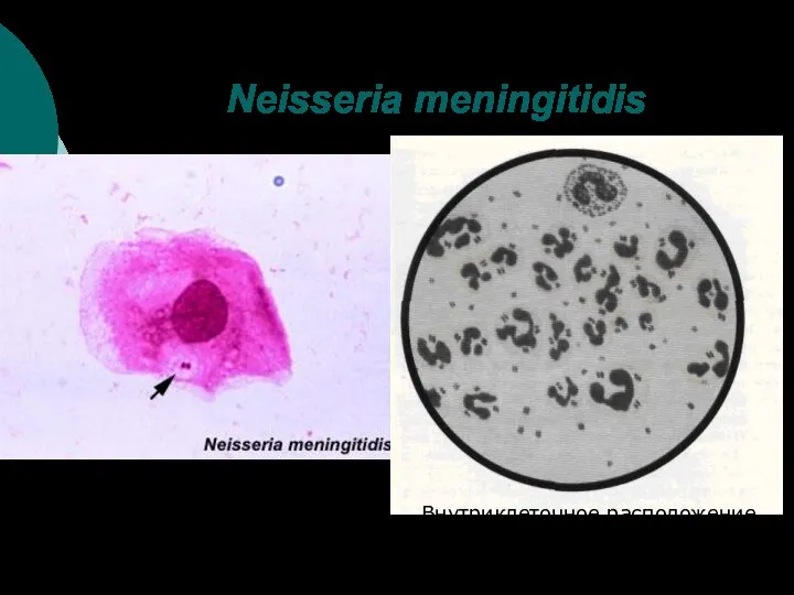 Neisseria meningitidis Внутриклеточное расположение менингококков в спинномозговой жидкости