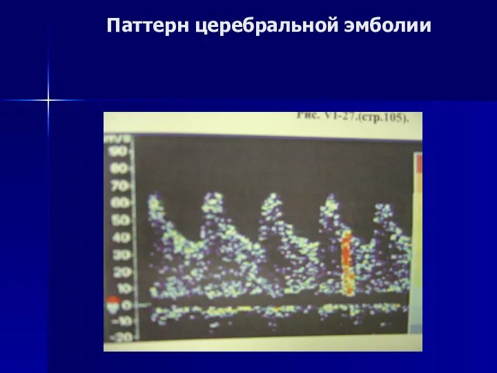 Паттерн церебральной эмболии