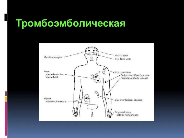 Тромбоэмболическая