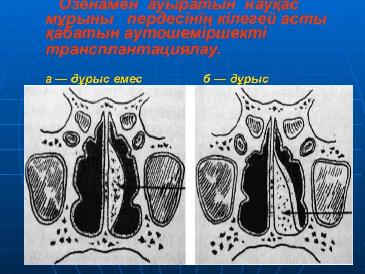 Озенамен ауыратын науқас мұрыны пердесінің кілегей асты қабатын аутошеміршекті трансплантациялау. а