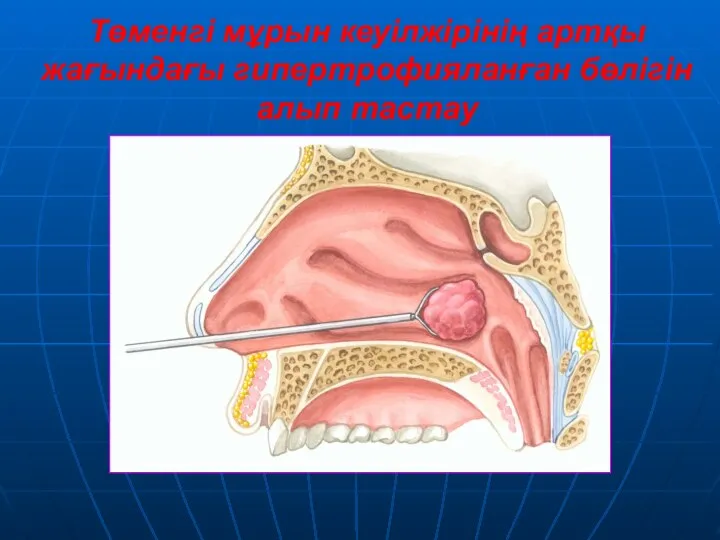 Төменгі мұрын кеуілжірінің артқы жағындағы гипертрофияланған бөлігін алып тастау