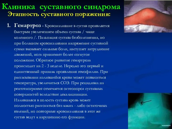 Этапность суставного поражения: Гемартроз - Кровоизлияние в сустав проявляется быстрым увеличением