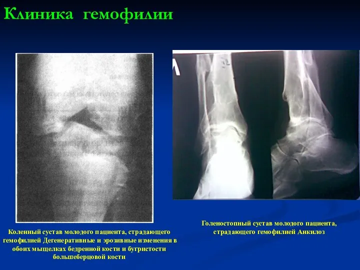 Клиника гемофилии Коленный сустав молодого пациента, страдающего гемофилией Дегенеративные и эрозивные