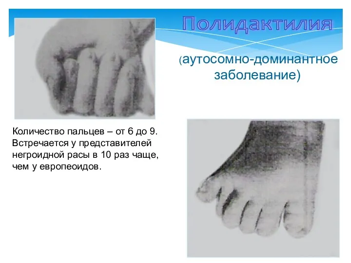 Полидактилия (аутосомно-доминантное заболевание) Количество пальцев – от 6 до 9. Встречается