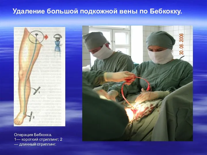 Удаление большой подкожной вены по Бебкокку. Операция Бебкокка. 1— короткий стриппинг; 2 — длинный стриппинг.