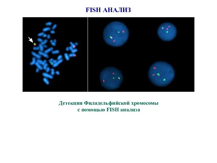 FISH АНАЛИЗ Детекция Филадельфийской хромосомы с помощью FISH анализа