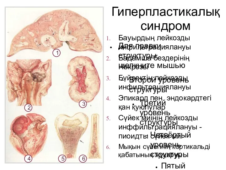 Бауырдың лейкозды инфильтрациялануы Бадамша бездерінің Некрозы Бүйректің лейкозды инфильтрациялануы Эпикард пен