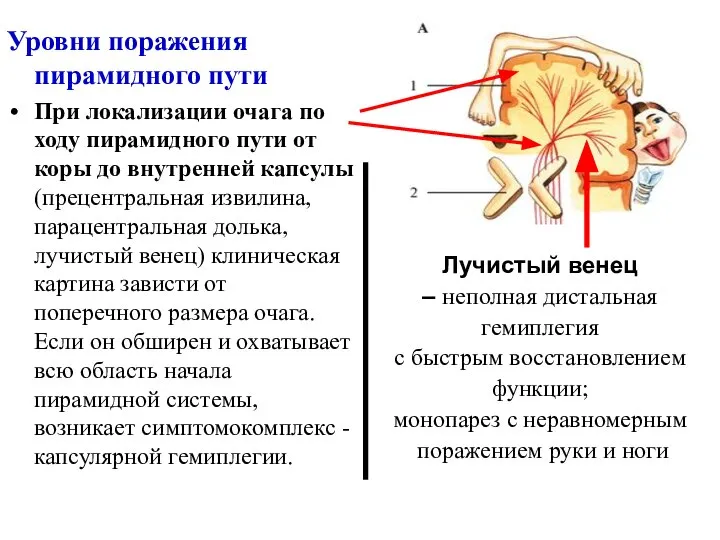 Уровни поражения пирамидного пути При локализации очага по ходу пирамидного пути