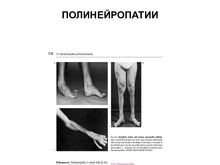 ПОЛИНЕЙРОПАТИИ