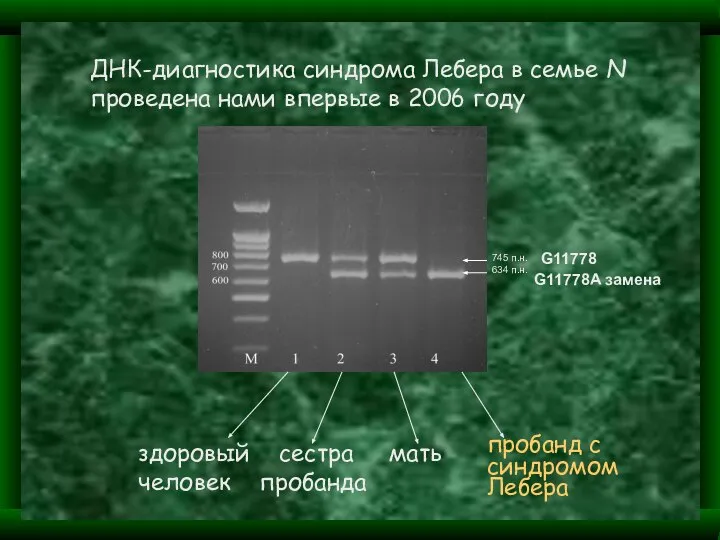 ДНК-диагностика синдрома Лебера в семье N проведена нами впервые в 2006