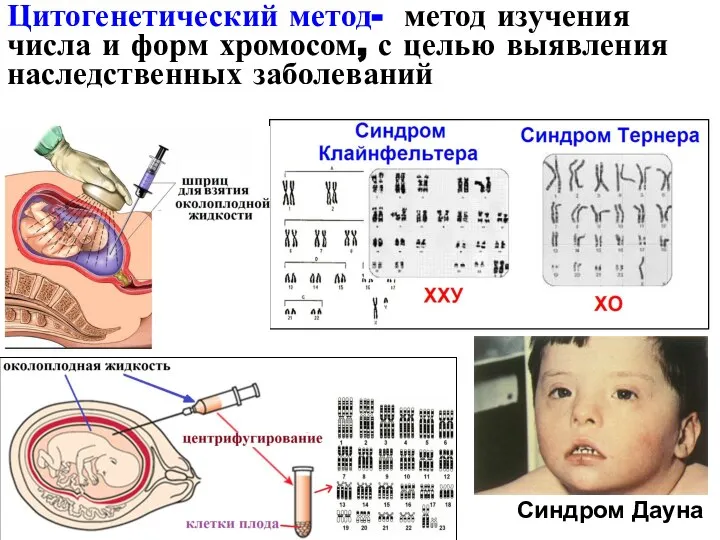 Цитогенетический метод- метод изучения числа и форм хромосом, с целью выявления наследственных заболеваний Синдром Дауна