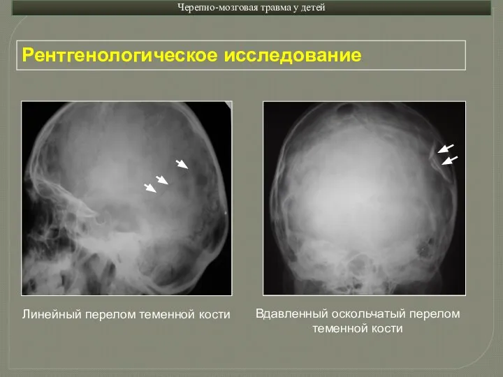 Черепно-мозговая травма у детей Рентгенологическое исследование Линейный перелом теменной кости Вдавленный оскольчатый перелом теменной кости