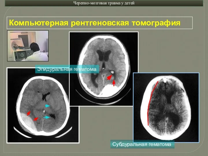 Черепно-мозговая травма у детей Компьютерная рентгеновская томография Эпидуральная гематома Субдуральная гематома