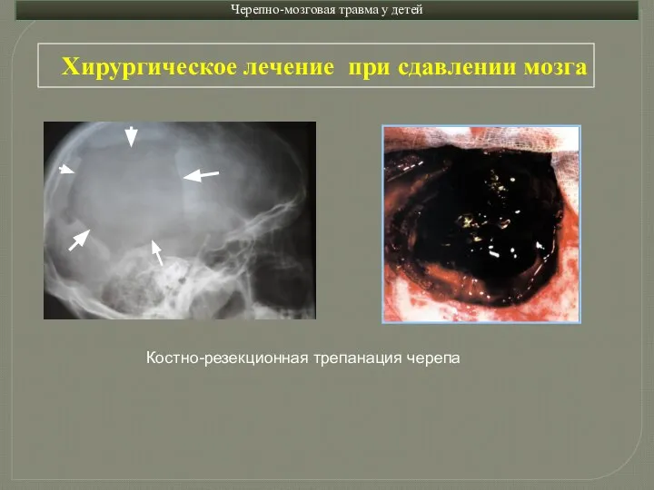 Черепно-мозговая травма у детей Хирургическое лечение при сдавлении мозга Костно-резекционная трепанация черепа