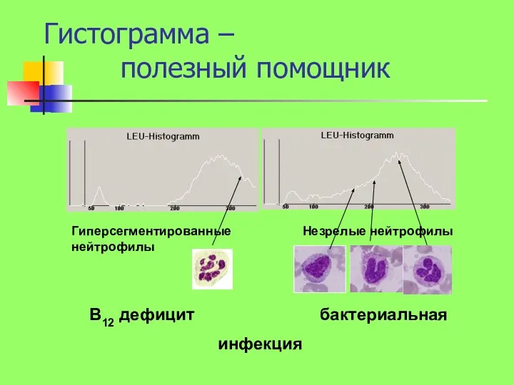 Гиперсегментированные нейтрофилы Незрелые нейтрофилы В12 дефицит бактериальная инфекция Гистограмма – полезный помощник