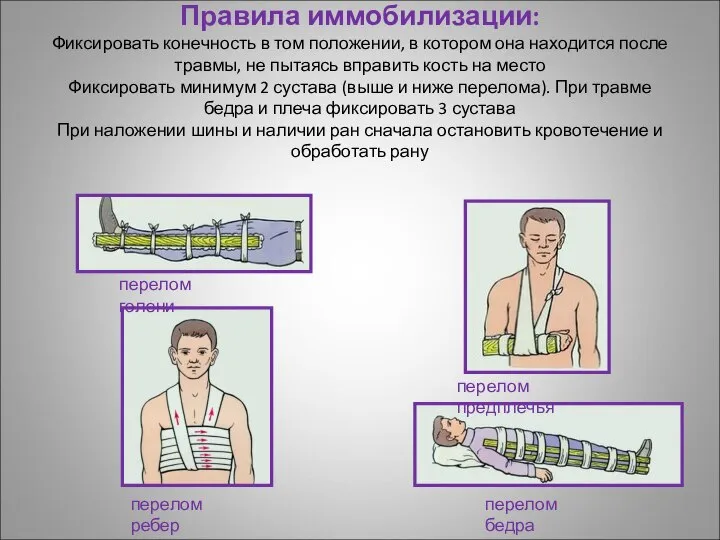 Правила иммобилизации: Фиксировать конечность в том положении, в котором она находится