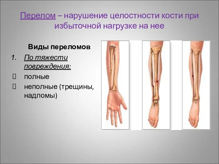 Перелом – нарушение целостности кости при избыточной нагрузке на нее Виды