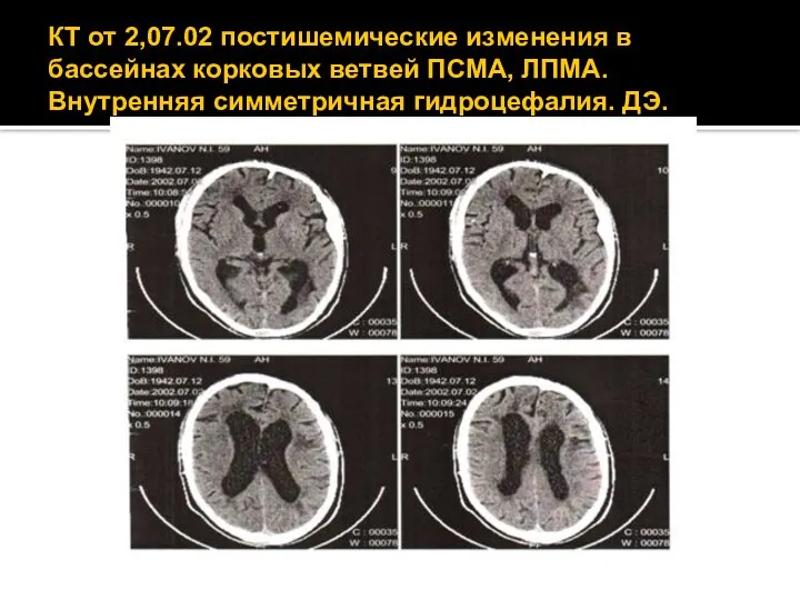 КТ от 2,07.02 постишемические изменения в бассейнах корковых ветвей ПСМА, ЛПМА. Внутренняя симметричная гидроцефалия. ДЭ.