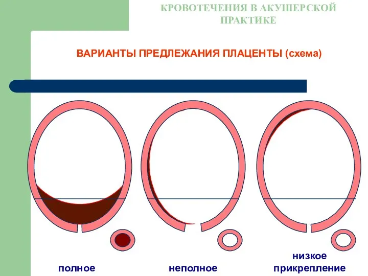 ВАРИАНТЫ ПРЕДЛЕЖАНИЯ ПЛАЦЕНТЫ (схема) КРОВОТЕЧЕНИЯ В АКУШЕРСКОЙ ПРАКТИКЕ полное неполное низкое прикрепление