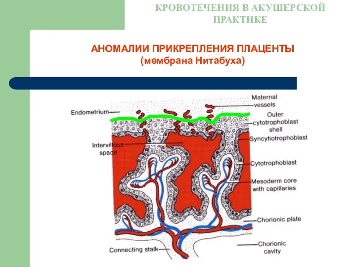 АНОМАЛИИ ПРИКРЕПЛЕНИЯ ПЛАЦЕНТЫ (мембрана Нитабуха) КРОВОТЕЧЕНИЯ В АКУШЕРСКОЙ ПРАКТИКЕ