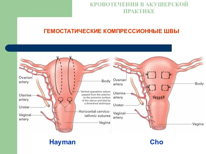 ГЕМОСТАТИЧЕСКИЕ КОМПРЕССИОННЫЕ ШВЫ КРОВОТЕЧЕНИЯ В АКУШЕРСКОЙ ПРАКТИКЕ Hayman Cho