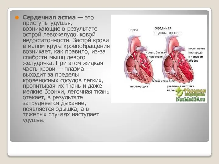 Сердечная астма — это приступы удушья, возникающие в результате острой левожелудочковой