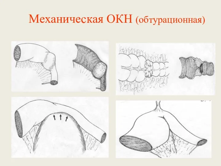 Механическая ОКН (обтурационная)