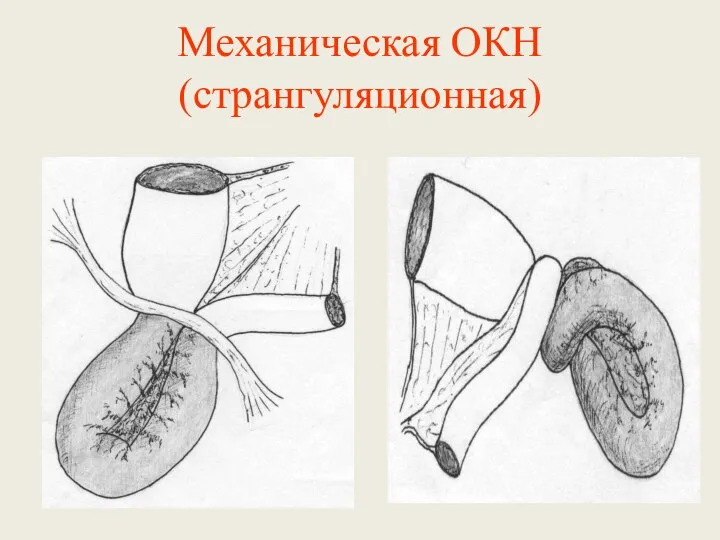 Механическая ОКН (странгуляционная)