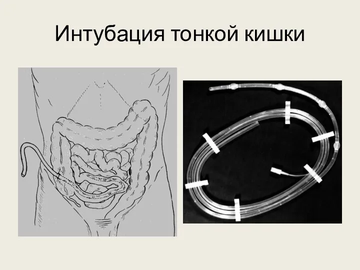 Интубация тонкой кишки