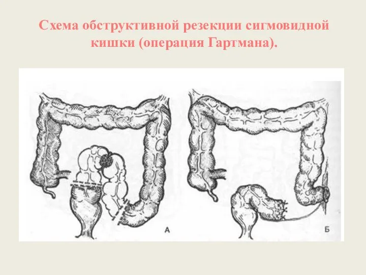 Схема обструктивной резекции сигмовидной кишки (операция Гартмана).