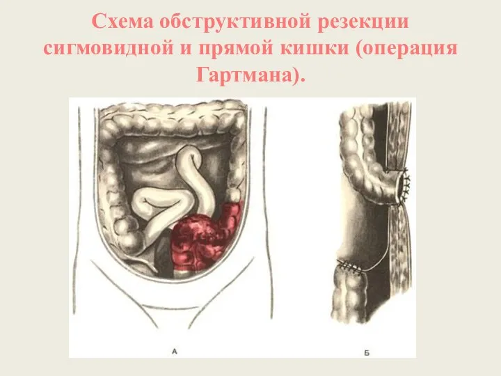 Схема обструктивной резекции сигмовидной и прямой кишки (операция Гартмана).