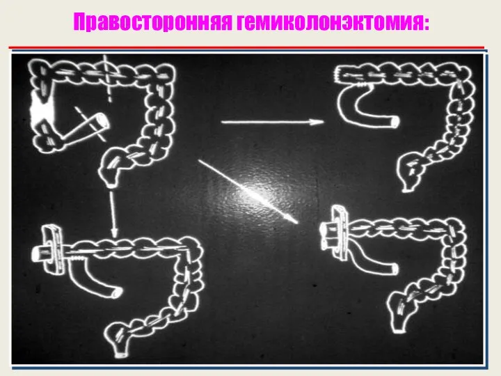 Правосторонняя гемиколонэктомия: